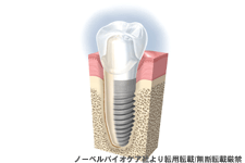 インプラント