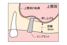 ソケットリフト