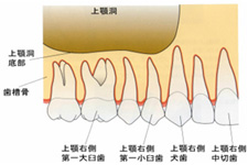 サイナスリフト1