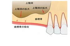 サイナスリフト2