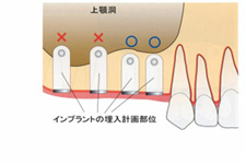 サイナスリフト3