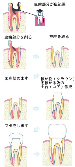 虫歯重度