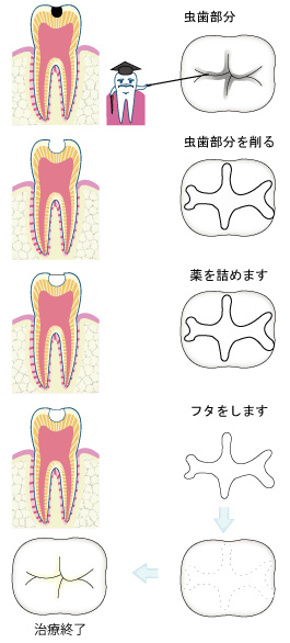虫歯軽度