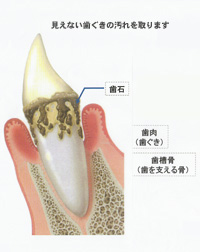歯周病予防